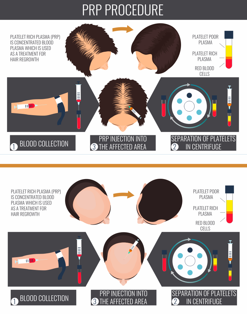 Platelet rich plasma (PRP) therapy for hair loss.