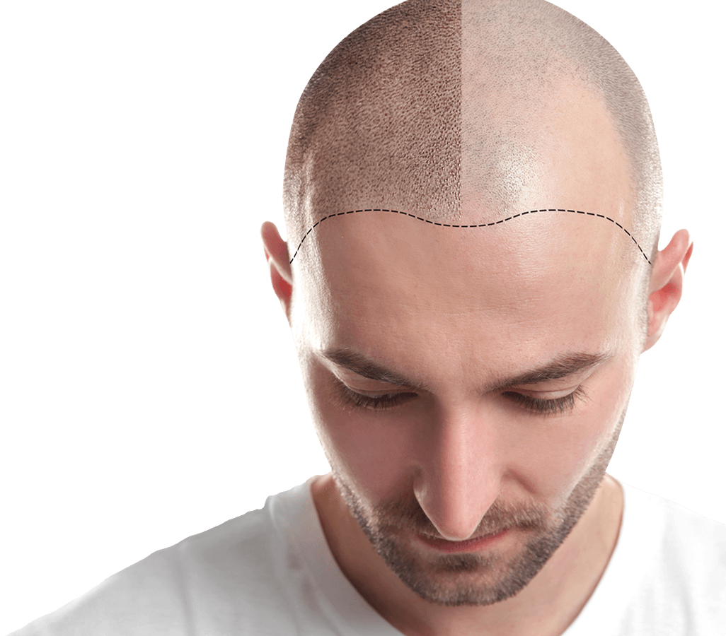 Low Cost Hair Transplant In Bhiwandi , 9872633771 - Health, Beauty &  Fitness Service In Aamne Village Bhiwandi - Click.in