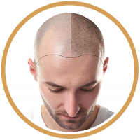 Scalp Micropigmentation