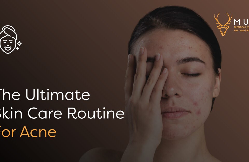 The Ultimate Skin Care Routine For Acne