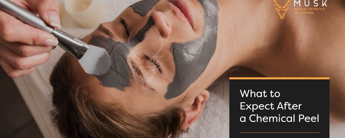 What to Expect After a Chemical Peel - A Definitive Guide