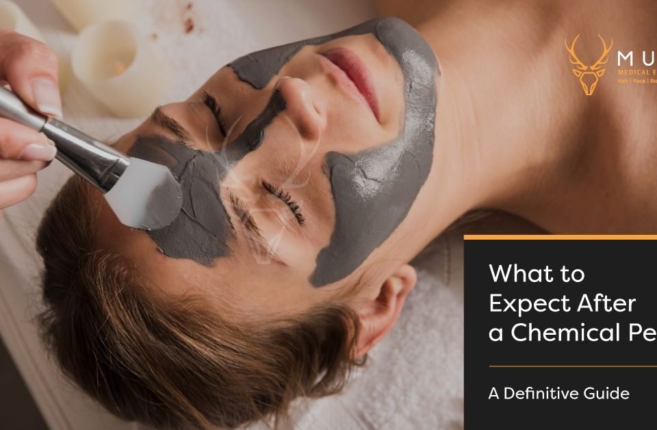 What to Expect After a Chemical Peel - A Definitive Guide