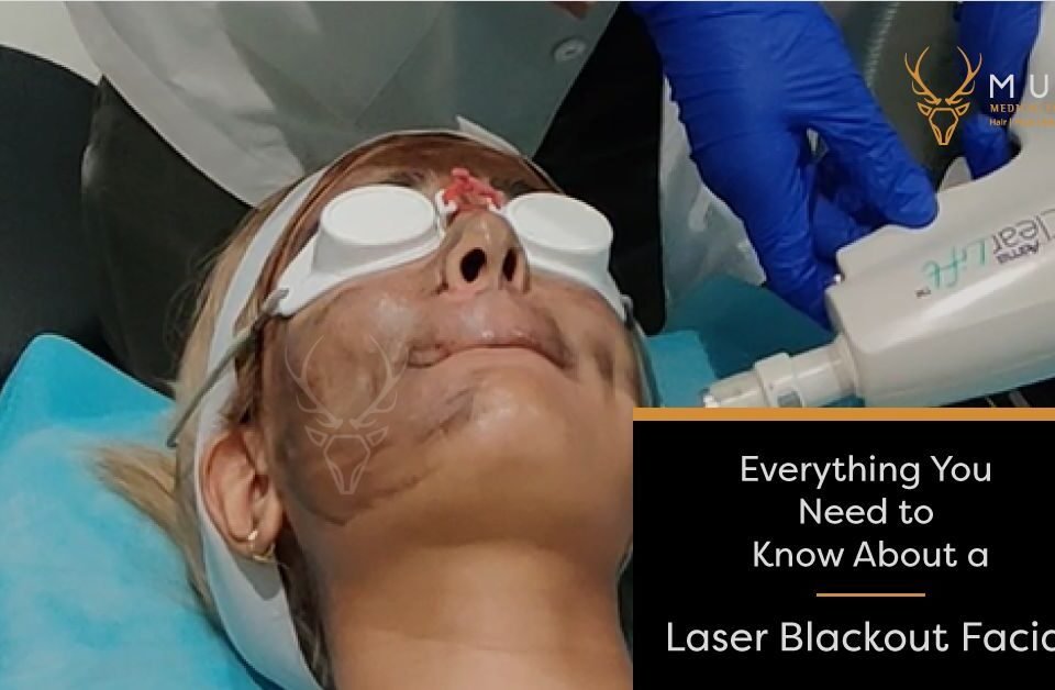 Everything You Need to Know About a Laser Blackout Facial