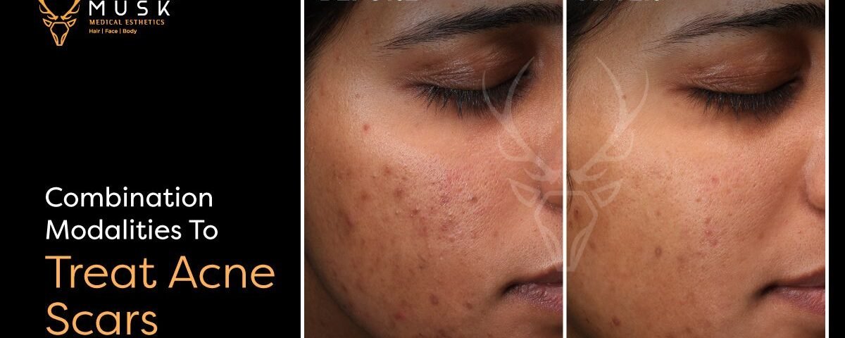 Combination Modalities To Treat Acne Scars