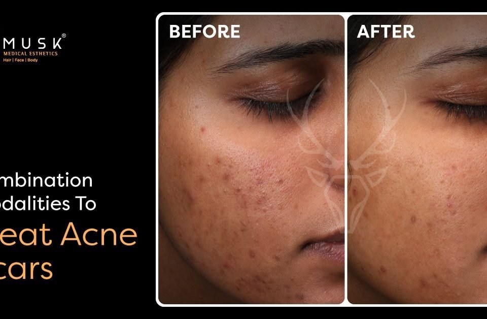 Combination Modalities To Treat Acne Scars