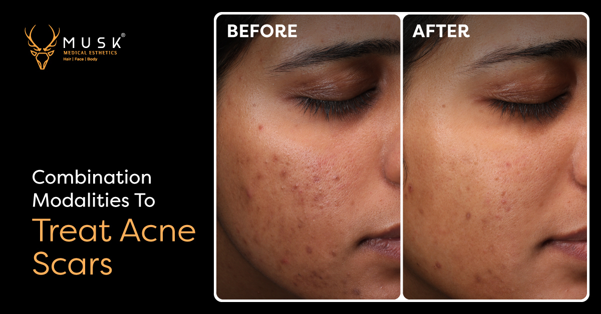 bacne scars treatment