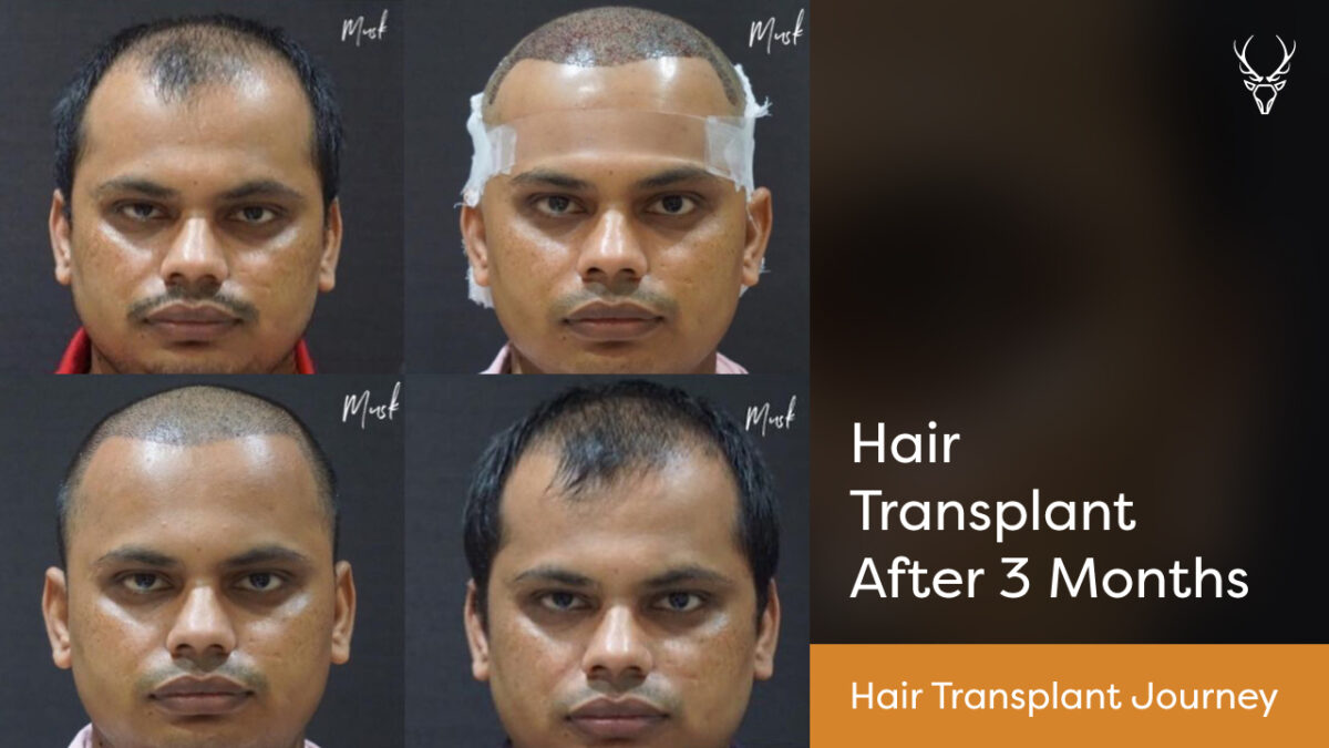 Hair Transplant and Treatment, Hair Treatment, Musk Clinic