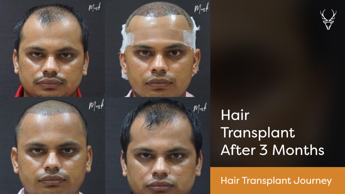 My Three Months Hair Condition After FUE Hair Transplant  NBCRUISER