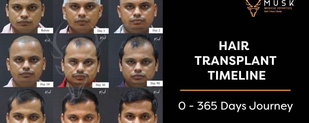 Hair Transplant After 3 Months Results, Growth Timeline and Photos
