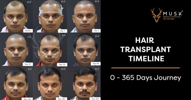 Hair Transplant After 3 Months Results, Growth Timeline and Photos