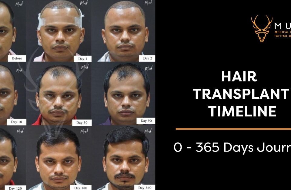 Hair Transplant After 3 Months Results, Growth Timeline and Photos