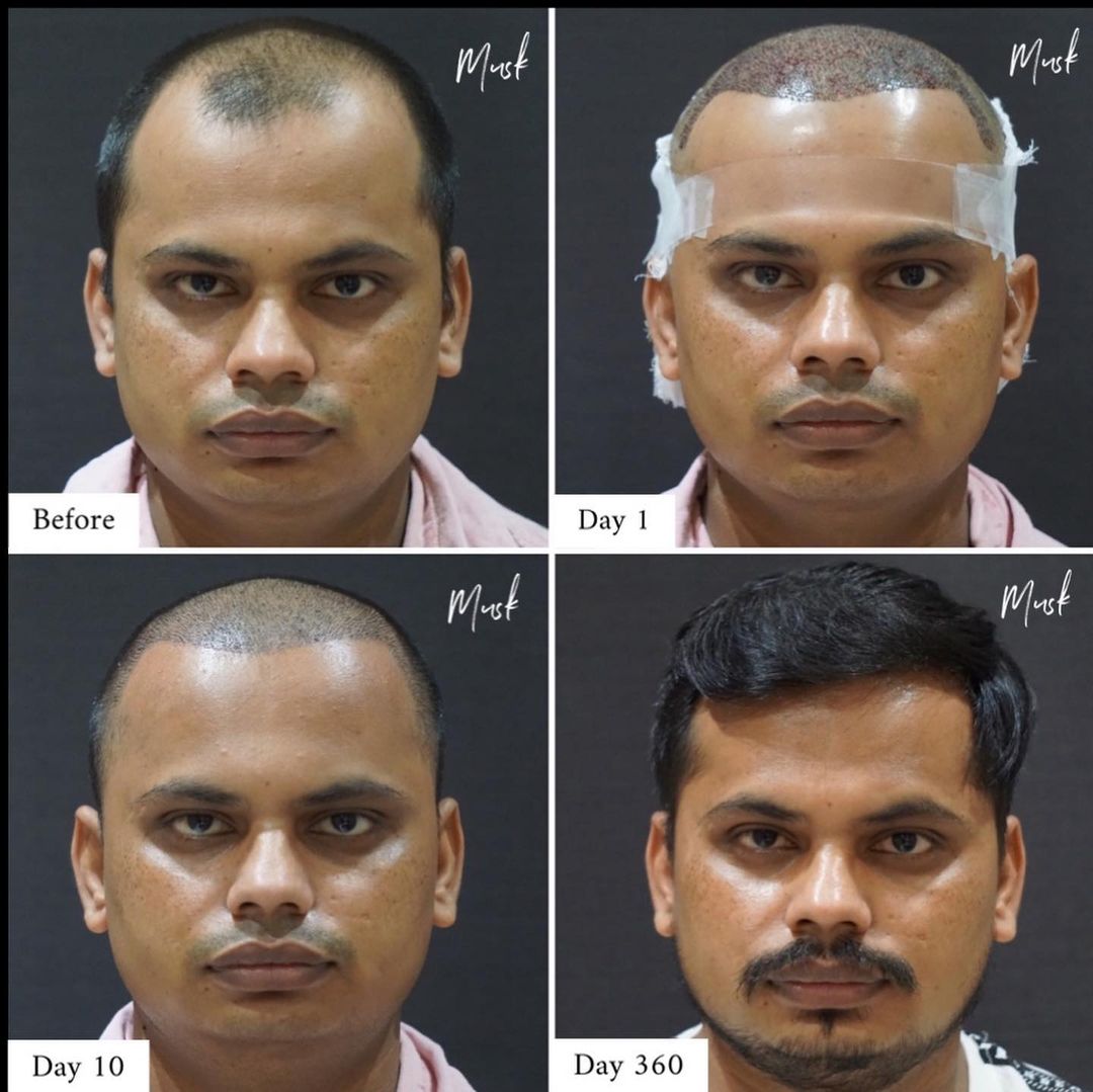 Hair Transplant Results After 3 Months  Hair Growth Images  Effects