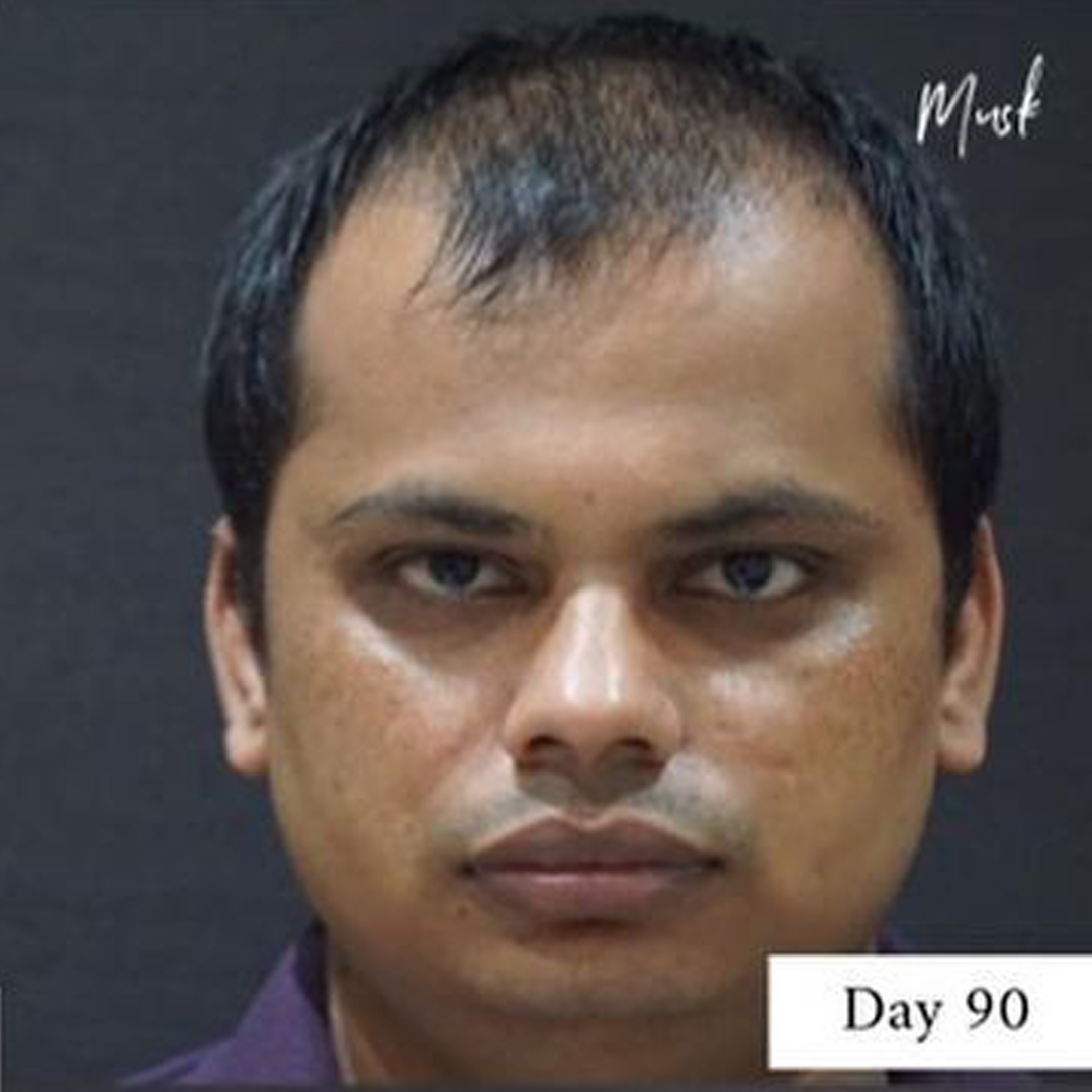 Hair Transplant Journey: Hair Transplant After 3 Months - Results