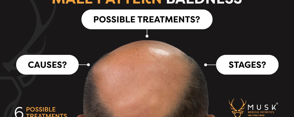 male-pattern-baldness-6-possible-treatment-muskclinic