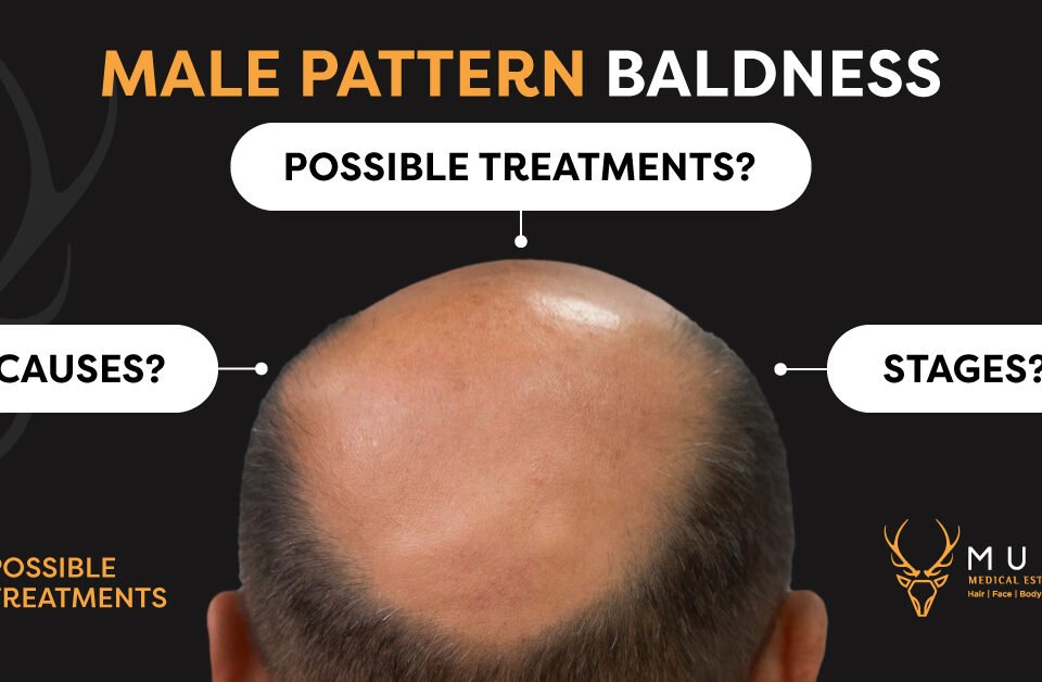 male-pattern-baldness-6-possible-treatment-muskclinic