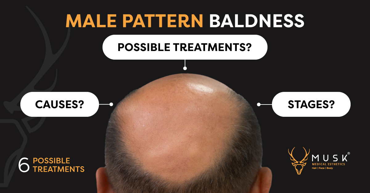 Male- or Female-Pattern Baldness: Alopecia Reversal