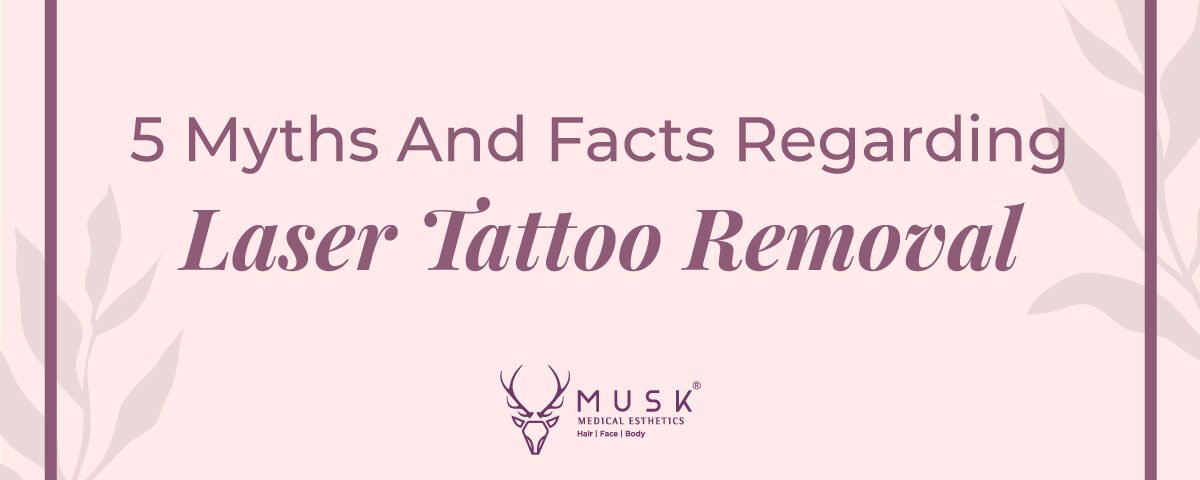 5 Myths And Facts Regarding Laser Tattoo Removal