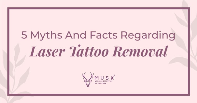 5 Myths And Facts Regarding Laser Tattoo Removal