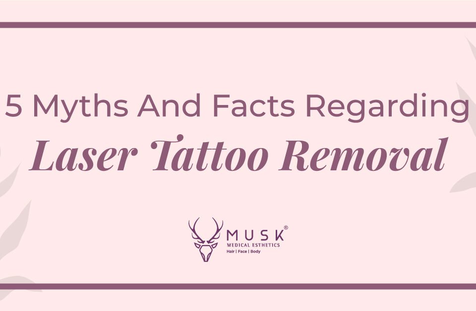 5 Myths And Facts Regarding Laser Tattoo Removal