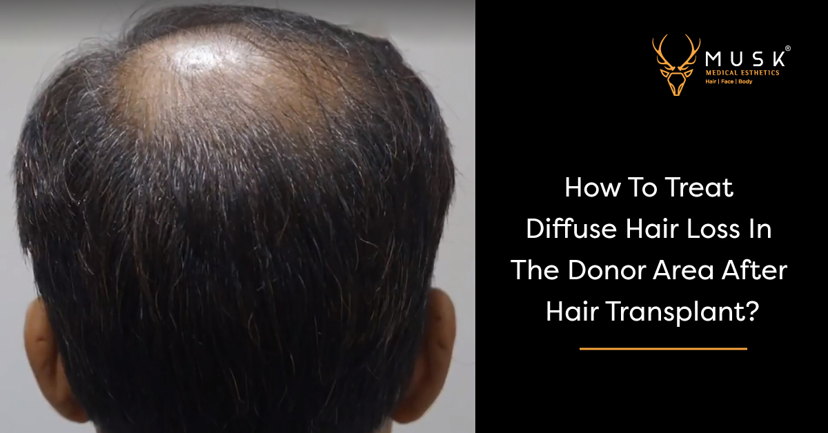 How To Treat Diffuse Hair Loss In The Donor Area After Hair Transplant?