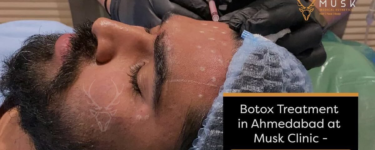 Botox Treatment in Ahmedabad at Musk Clinic - A Detailed Guide