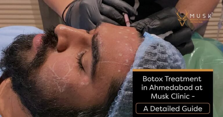 Botox Treatment in Ahmedabad at Musk Clinic - A Detailed Guide