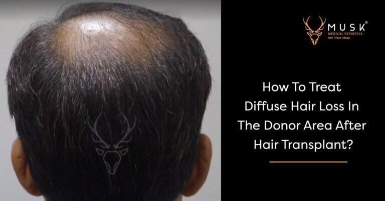 How To Treat Diffuse Hair Loss In The Donor Area After Hair Transplant