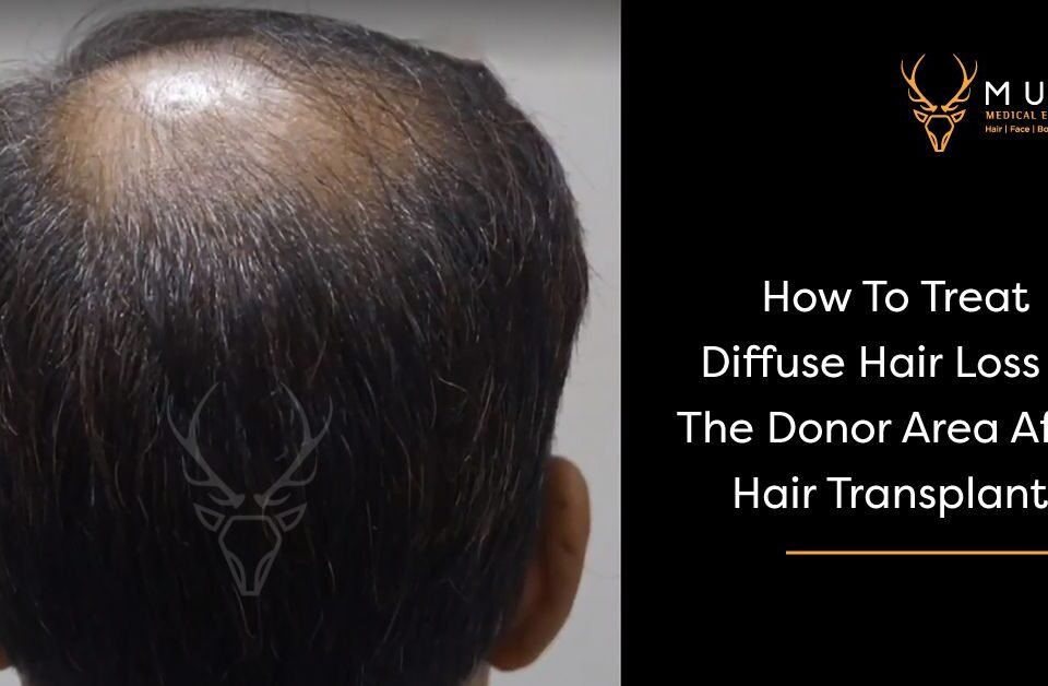 How To Treat Diffuse Hair Loss In The Donor Area After Hair Transplant