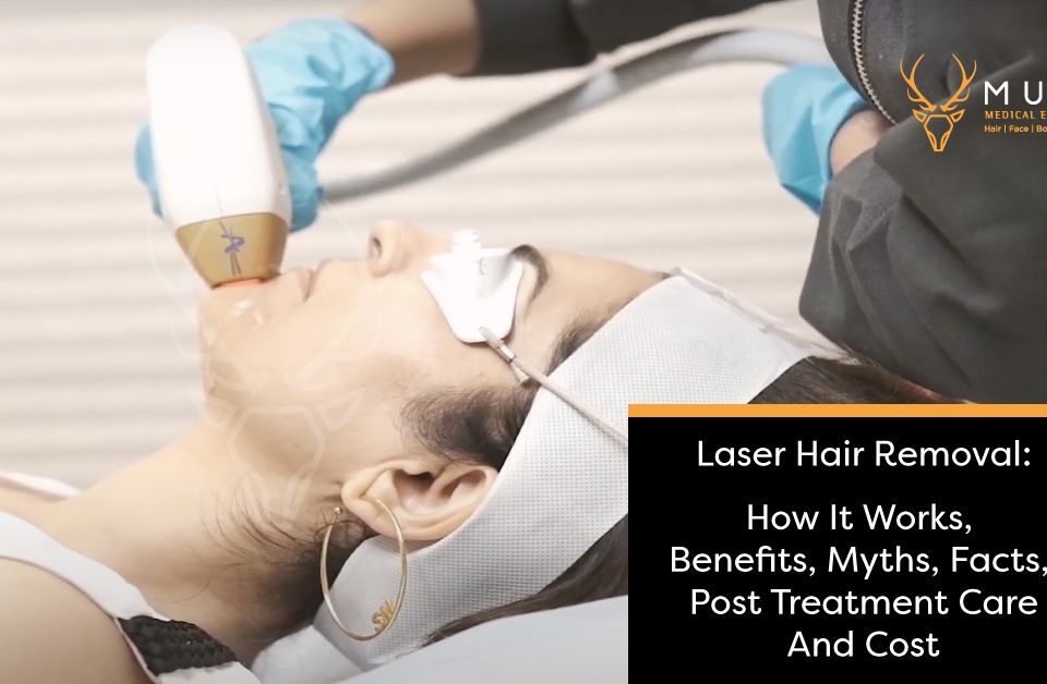 Laser Hair Removal How It Works, Benefits, Myths, Facts, Post Treatment Care, and Cost
