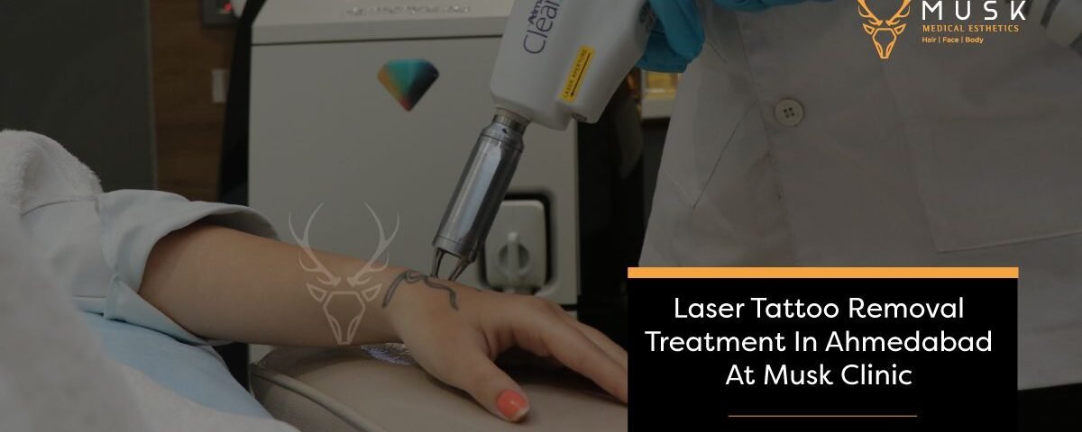 Laser Tattoo Removal Treatment In Ahmedabad At Musk Clinic - A Complete Guide