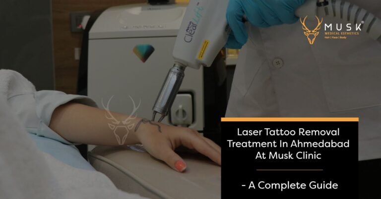 Laser Tattoo Removal Treatment In Ahmedabad At Musk Clinic - A Complete Guide