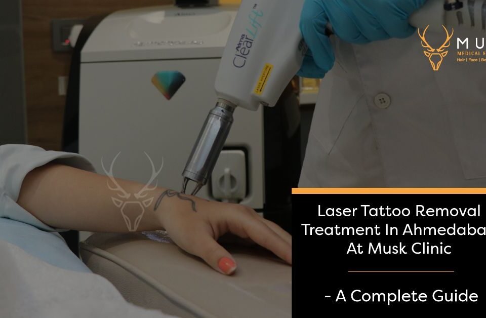 Laser Tattoo Removal Treatment In Ahmedabad At Musk Clinic - A Complete Guide