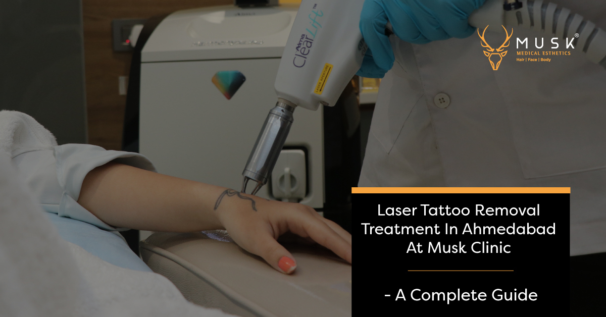 Why Laser Tattoo Removal is Better than Its Alternative Methods   DermaWorld Skin Clinic