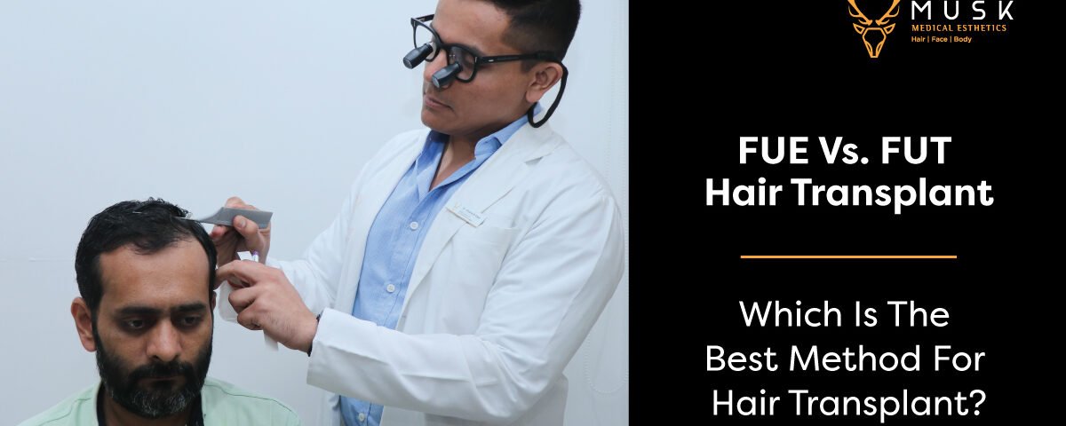 FUE Vs. FUT Hair Transplant Which Is The Best Method For Hair Transplant