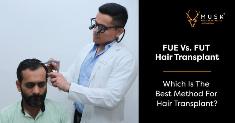FUE Vs. FUT Hair Transplant Which Is The Best Method For Hair Transplant