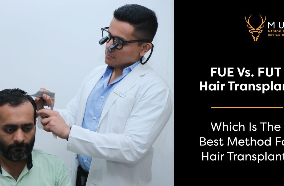 FUE Vs. FUT Hair Transplant Which Is The Best Method For Hair Transplant