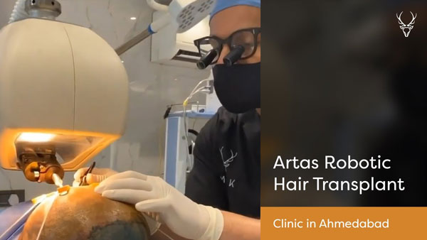 Hair Transplant in Ahmedabad, Hair Transplant Cost, Hair Treatment