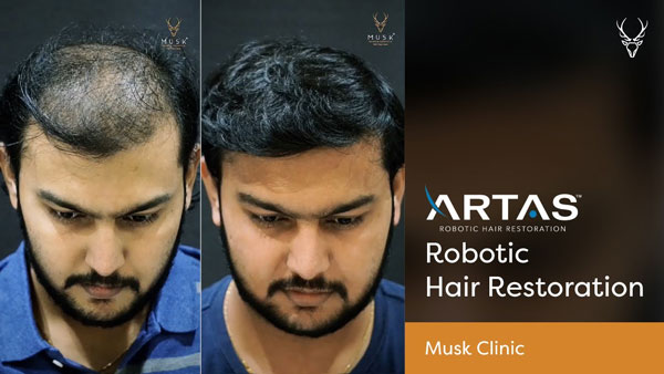 Hair Transplant in Ahmedabad  HFHF Patient Hair Journey