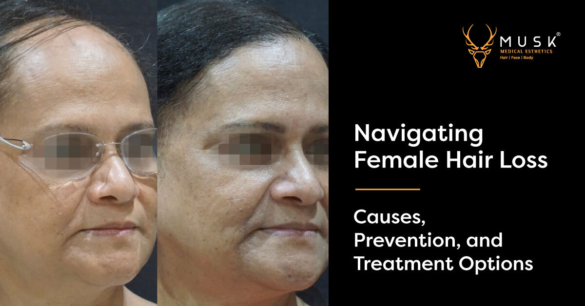 Female hair loss (causes and management) | PPT
