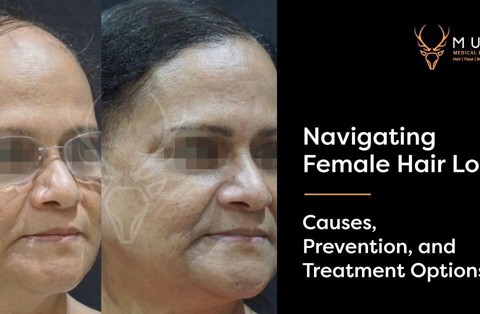 Navigating Female Hair Loss Causes, Prevention, and Treatment Options