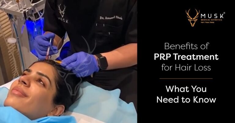 Benefits of PRP Treatment for Hair Loss What You Need to Know