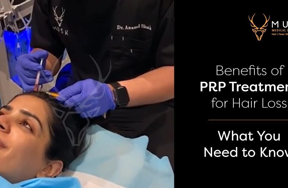 Benefits of PRP Treatment for Hair Loss What You Need to Know