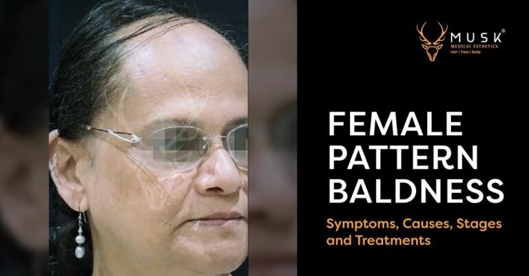 Female Pattern Baldness Symptoms, Causes, Stages, and Treatments