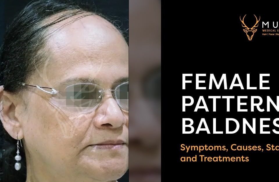Female Pattern Baldness Symptoms, Causes, Stages, and Treatments