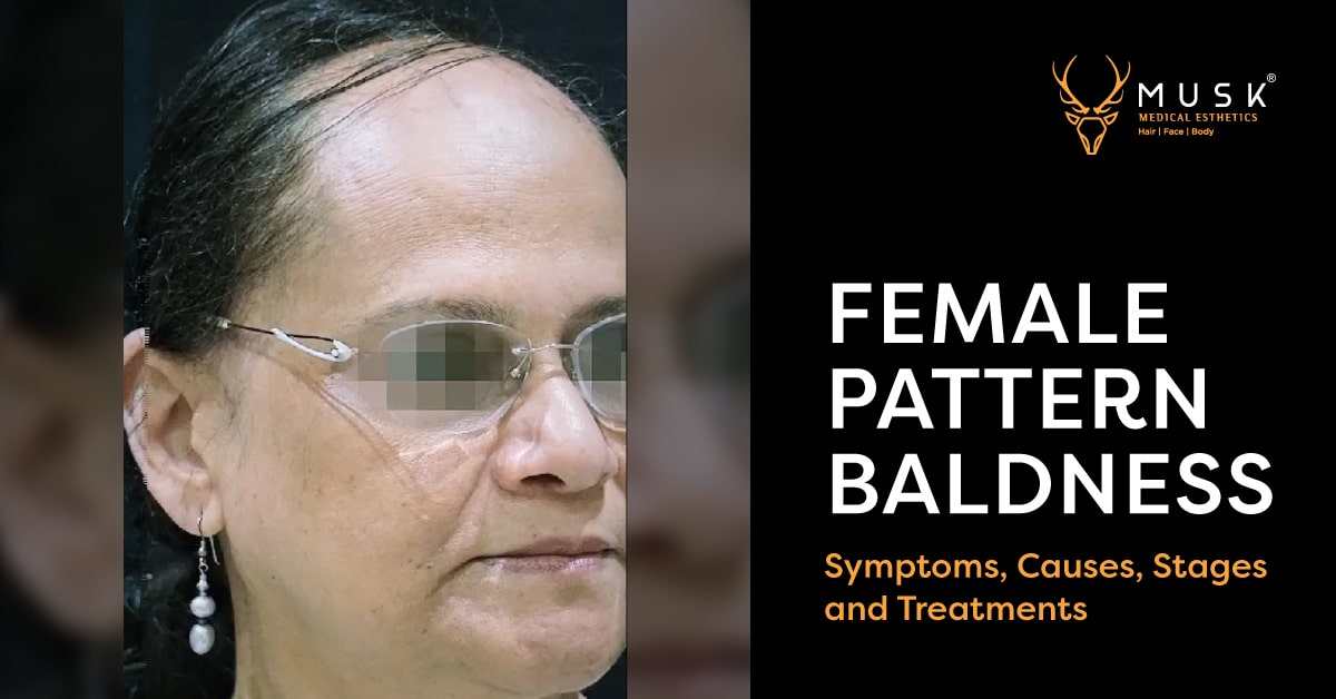 Female Pattern Baldness: Symptoms, Stages, Causes & Treatment