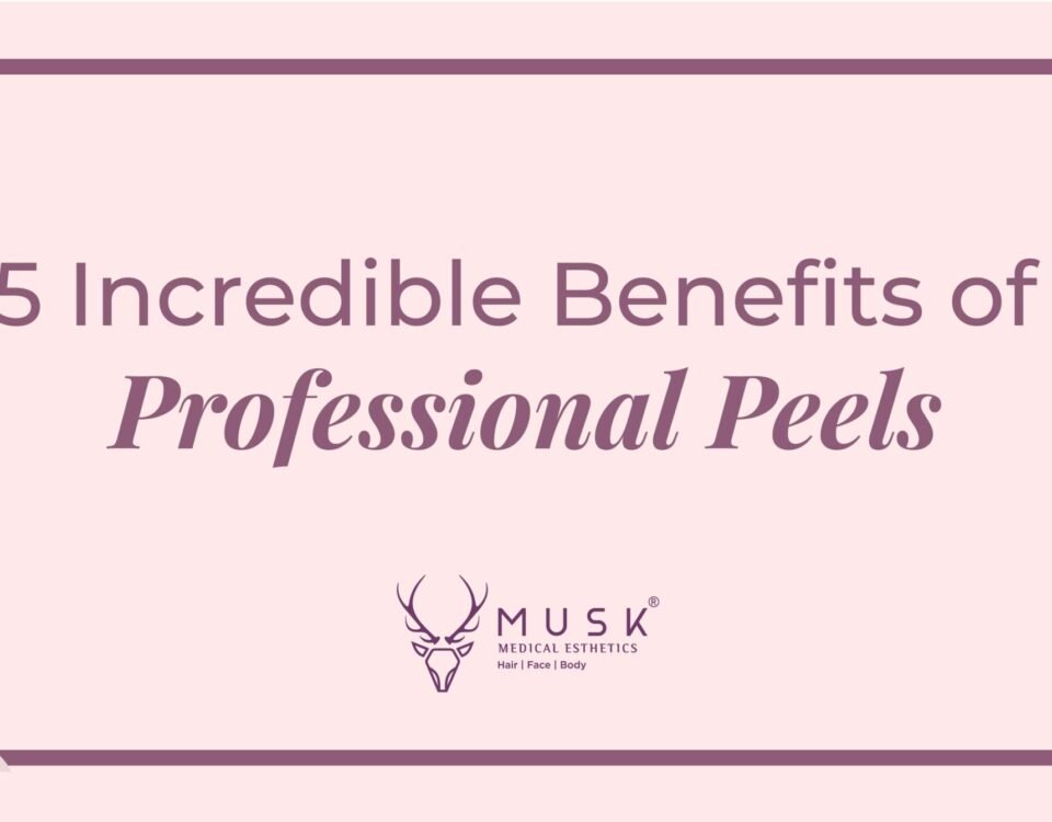 5 Incredible Benefits of Professional Peels