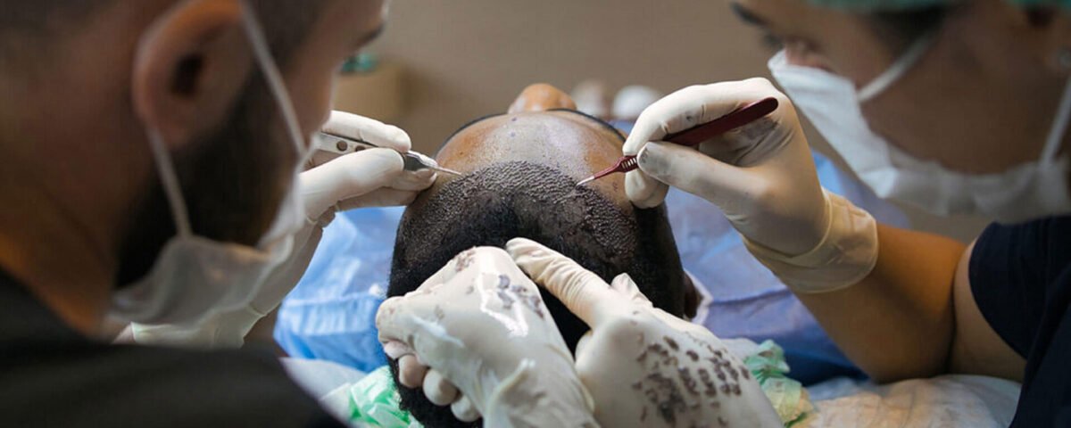Hair Transplants: A Comprehensive Guide for Cancer Survivors