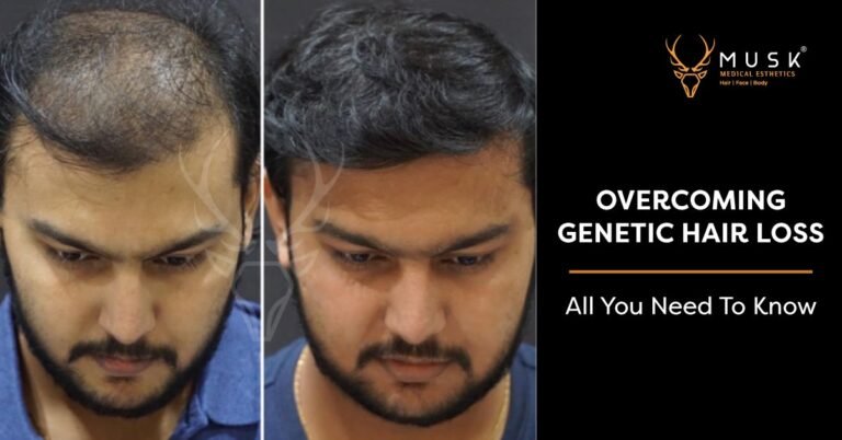 Overcoming Genetic Hair Loss: All You Need To Know