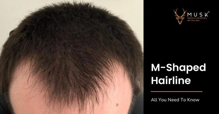 M-Shaped Hairline - All You Need To Know