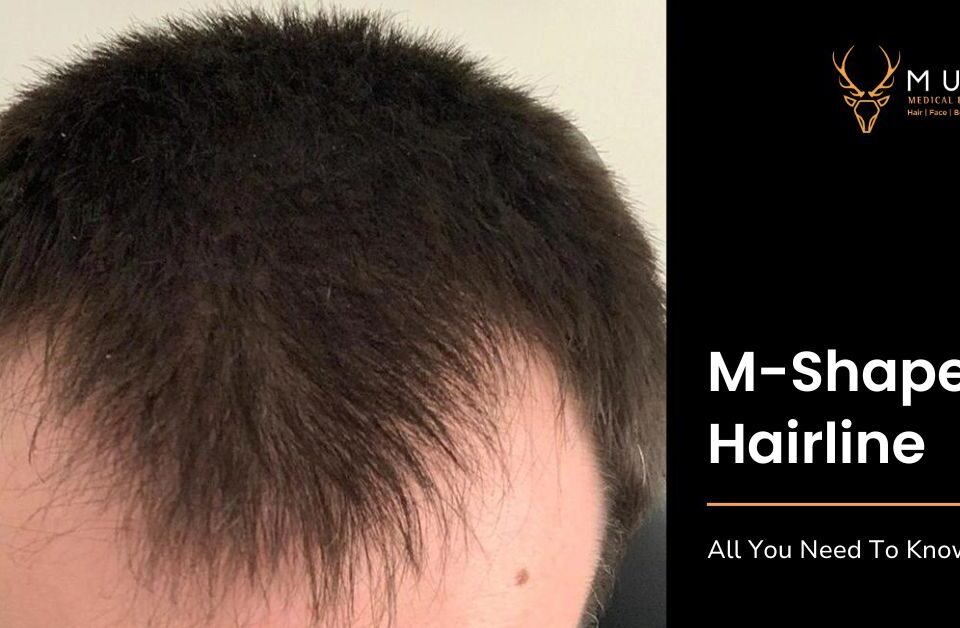 M-Shaped Hairline - All You Need To Know